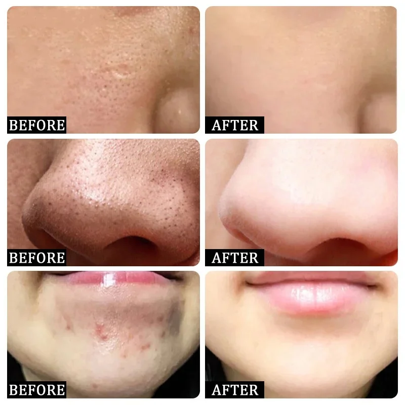 살리실산 모공 클리어링 크림 모공 축소 블랙헤드 제거  - Korean Skincare Routine 리뷰 및 가격
