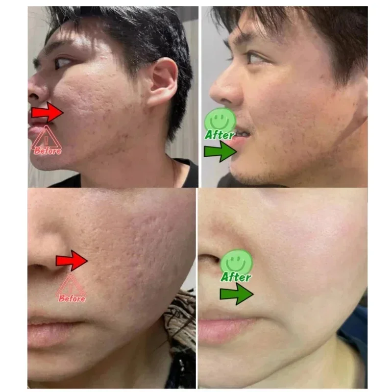 살리실산 모공 클리어링 크림 모공 축소 블랙헤드 제거  - Korean Skincare Routine 리뷰 및 가격
